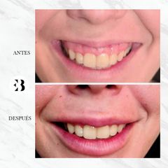 Sonrisa Gingival - Dra Elena Berezo