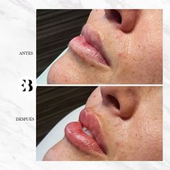 Aumento de labios - Dra Elena Berezo