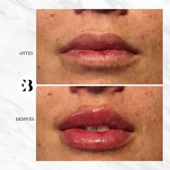 Aumento de labios - Dra. Elena Berezo