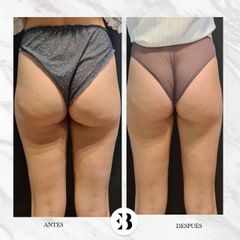 Mesoterapia - Dra. Elena Berezo