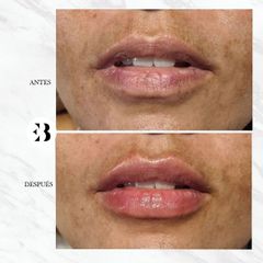 Aumento de labios - Dra. Elena Berezo