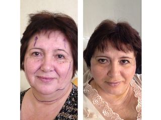 Antes y después Lifting facial y aumento de labios con Permalip