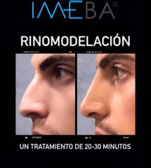 Rinomodelación - Clinicas IMEBA®