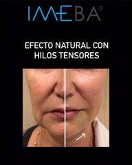 Hilos tensores - Clinicas IMEBA®