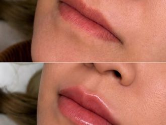 Aumento labios antes y después - 880487