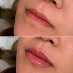 Clinicas IMEBA® - Aumento de labios