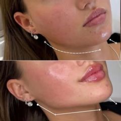 Clinicas IMEBA® - Ácido Hialurónico