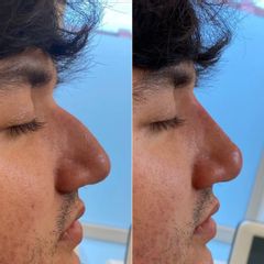 Clinicas IMEBA® - Rinomodelación