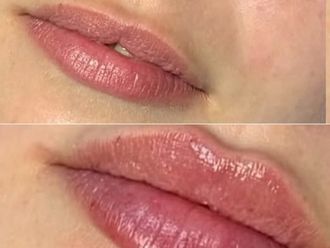 Aumento labios antes y después - 880491