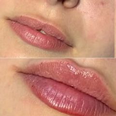 Clinicas IMEBA® - Aumento de labios