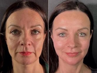 Rejuvenecimiento facial antes y después - 880492