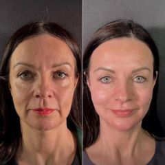 Clinicas IMEBA® - Rejuvenecimiento facial