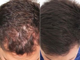 Tratamiento capilar antes y después - 880493