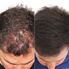 Clinicas IMEBA® - Tratamiento capilar