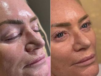 Rejuvenecimiento facial antes y después - 880494