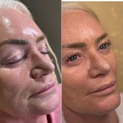 Clinicas IMEBA® - Rejuvenecimiento facial
