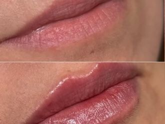Aumento labios antes y después - 880495