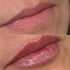 Clinicas IMEBA® - Aumento de labios