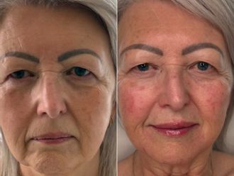 Rejuvenecimiento facial antes y después - 880496
