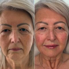 Clinicas IMEBA® - Rejuvenecimiento facial