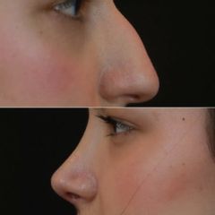 Clinicas IMEBA® - Rinomodelación