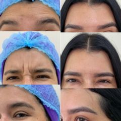 Clinicas IMEBA® - Eliminación de arrugas