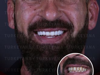 Blanqueamiento dental - 839967