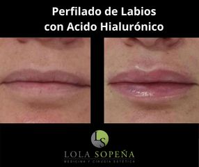 Aumento de labios - Clinicas Lola Sopeña