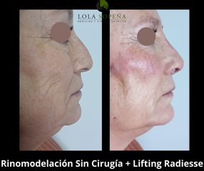 Rinomodelación Sin Cirugía + Lifting Radiesse - Clinicas Lola Sopeña