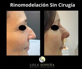 Rinomodelación - Clinicas Lola Sopeña