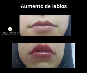 Aumento de labios - Clinicas Lola Sopeña