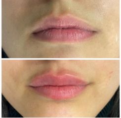 Aumento de labios - Marista Clínica