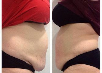 Antes y después Operación bikini exprés