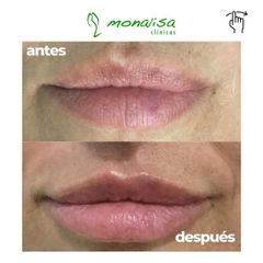 Aumento de labios - Monalisa Clínicas