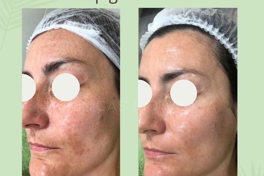 Microneedling antes y después - 826136