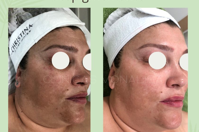 Microneedling antes y después - 826137