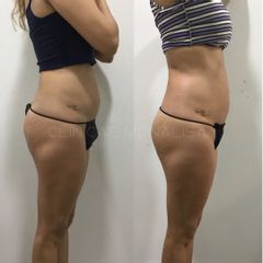 Tratamiento obesidad - Monalisa Clínicas
