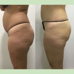 Tratamiento reductor en abdomen - Monalisa Clínicas