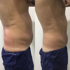 Reducción y remodelado corporal - Monalisa Clínicas