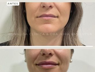 Aumento labios antes y después - 872776