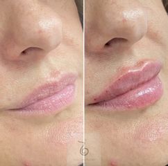 Aumento de labios - Dra. Lara Bañúls Laguía