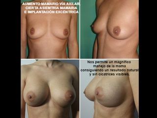 Antes y después Aumento de pecho