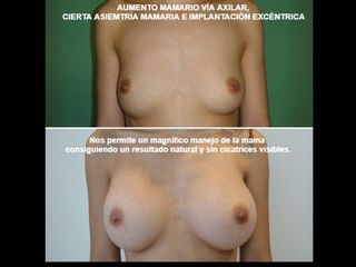Antes y después Aumento de pecho