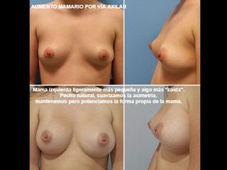 Antes y después Aumento de pecho