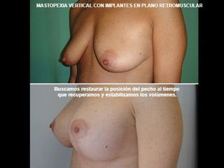 Antes y después Mastopexia