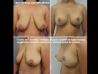 Mastopexia - Dr. José Mª Triviño