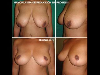 Antes y después Reducción de senos