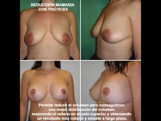 Antes y después Reducción de senos