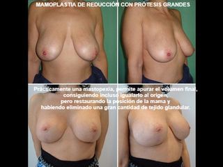 Antes y después Reducción de senos