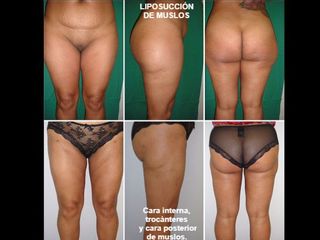 Antes y después Liposucción